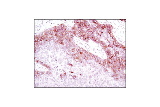 Immunohistochemical analysis of paraffin-embedded human lung carcinoma using TrkB (80G2) Rabbit mAb.
