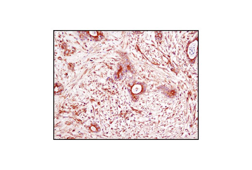 Immunohistochemical analysis of paraffin-embedded human colon carcinoma using α-Tubulin (DM1A) Mouse mAb.