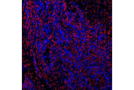 Confocal immunofluorescent analysis of paraffin-embedded SK-OV-3 xenograft using Pan-Keratin (C11) Mouse mAb (Alexa Fluor ® 647 Conjugate) (blue). Red= Propidium iodide (PI)/RNase Staining Solution.
