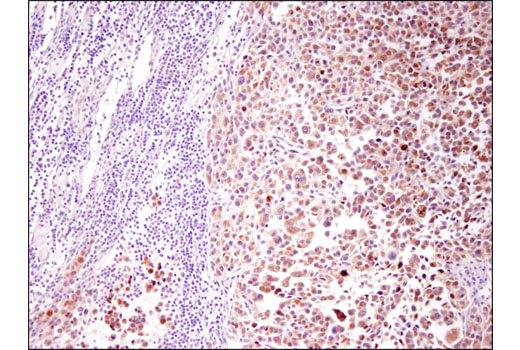 Immunohistochemical analysis of human melanoma tissue using Tyrosinase (T311) Mouse mAb (IHC Specific).