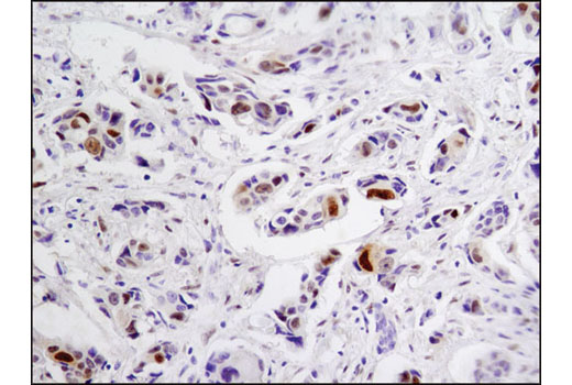 Immunohistochemical analysis of paraffin-embedded human breast carcinoma using Vitamin D3 Receptor (D2K6W) Rabbit mAb.