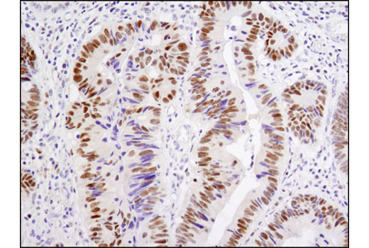 Immunohistochemical analysis of paraffin-embedded human colon carcinoma using Vitamin D3 Receptor (D2K6W) Rabbit mAb.