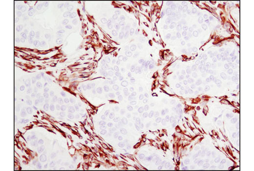 Immunohistochemical analysis of paraffin-embedded human breast carcinoma using Vimentin (D21H3) XP ® Rabbit mAb.