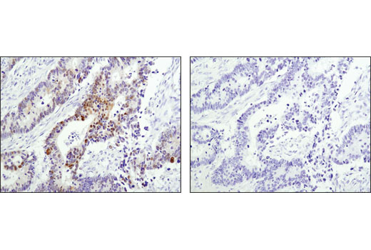 Immunohistochemical analysis of paraffin-embedded human colon carcinoma using Wee1 (D10D2) Rabbit mAb in the presence of control peptide (left) or antigen-specific peptide (right).