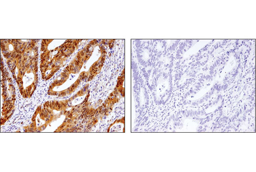 Immunohistochemical analysis of paraffin-embedded human colon adenocarcinoma, control (left) or λ-phosphatase treated (right), using Phospho-YAP (Ser127) (D9W2I) Rabbit mAb.