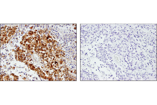 Immunohistochemical analysis of paraffin-embedded human non-small cell lung carcinoma using Phospho-YAP (Ser127) (D9W2I) Rabbit mAb in the presence of control peptide (left) or antigen-specific peptide (right).