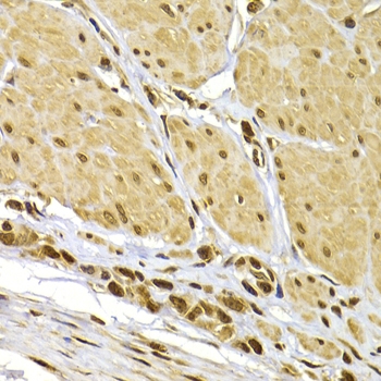 ARG55205 anti-S100A4 antibody IHC image Immunohistochemistry: paraffin-embedded human stomach cancer stained with ARG55205 anti-S100A4 antibody at 1:100 dilution.