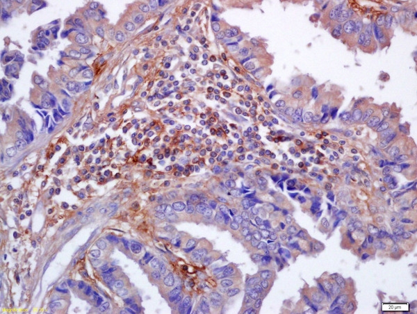 ARG55896 anti-Nrf2 phospho (Ser40) antibody IHC-P image Immunohistochemistry: Formalin-fixed and paraffin-embedded Human lung carcinoma stained with ARG55896 anti-Nrf2 phospho (Ser40) antibody at 1:200 dilution.