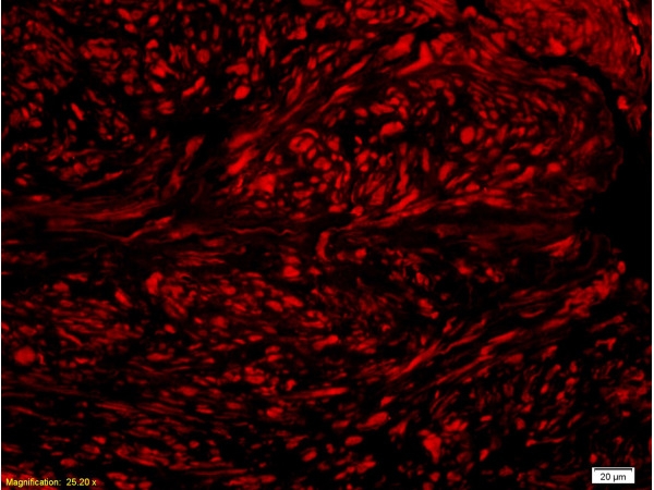 ARG55896 anti-Nrf2 phospho (Ser40) antibody IHC-P image Immunohistochemistry: Formalin-fixed and paraffin-embedded Human colon carcinoma tissue stained with ARG55896 anti-Nrf2 phospho (Ser40) antibody at 1:200 dilution.