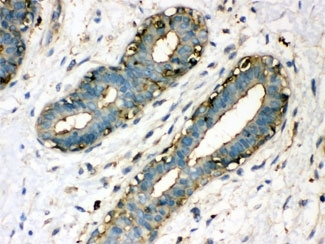 ARG10593 anti-TGM2 antibody IHC-P image Immunohistochemistry: Human breast cancer stained with ARG10593 anti-TGM2 antibody.