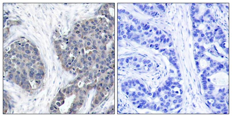 ARG51198 anti-Stathmin 1 antibody IHC-P image Immunohistochemistry: paraffin-embedded human breast carcinoma tissue stained with anti-Stathmin 1 antibody ARG51198 (left) or the same antibody preincubated with blocking peptide (right).