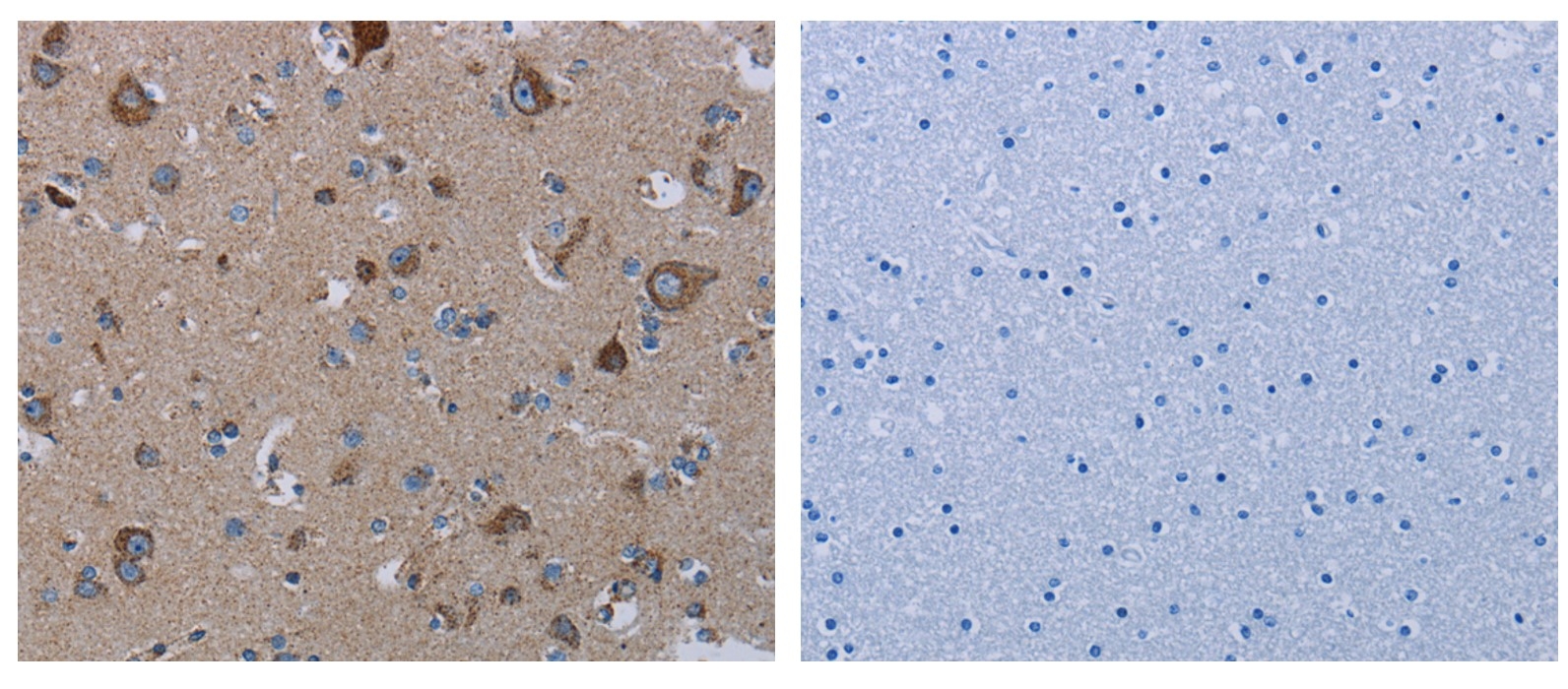 ARG65578 anti-NDUFS8 Antibody IHC-P image Immunohistochemistry: paraffin-embedded Human thyroid cancer tissue stained with ARG65578 NDUFS8 Antibody (left) at 1/20 dilution, or the same antibody preincubated with fusion protein (right). (Original magnification: ×200)