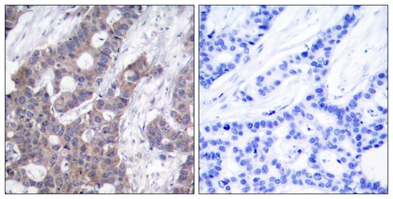 ARG51724 anti-Stathmin 1 phospho (Ser16) antibody IHC-P image Immunohistochemistry: paraffin-embedded human breast carcinoma tissue stained with anti-Stathmin 1 (phospho Ser16) antibody ARG51724 (left) or the same antibody preincubated with blocking peptide (right).