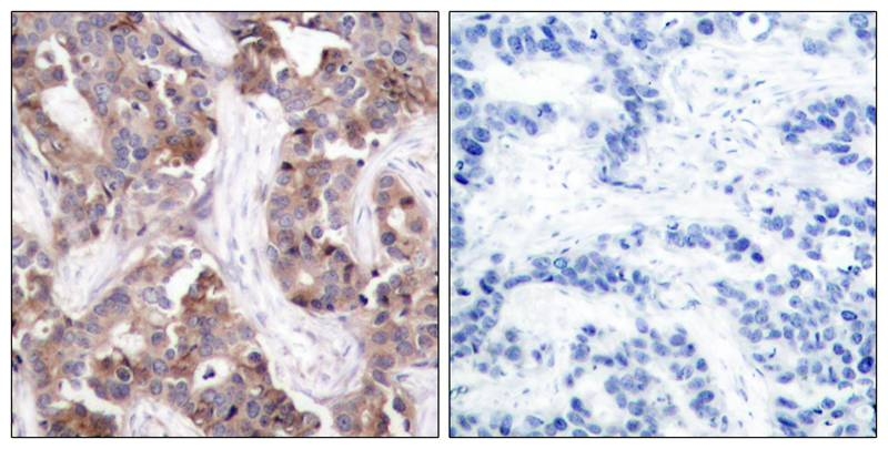 ARG51715 anti-Stathmin 1 phospho (Ser25) antibody IHC-P image Immunohistochemistry: paraffin-embedded human breast carcinoma tissue stained with anti-Stathmin 1 (phospho Ser25) antibody ARG51715 (left) or the same antibody preincubated with blocking peptide (right).