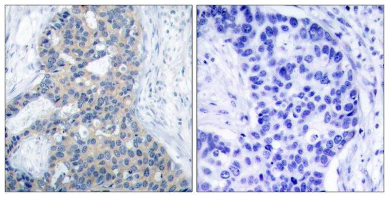 ARG51716 anti-Stathmin 1 phospho (Ser38) antibody IHC-P image Immunohistochemistry: paraffin-embedded human breast carcinoma tissue stained with anti-Stathmin 1 (phospho Ser38) antibody ARG51716 (left) or the same antibody preincubated with blocking peptide (right).