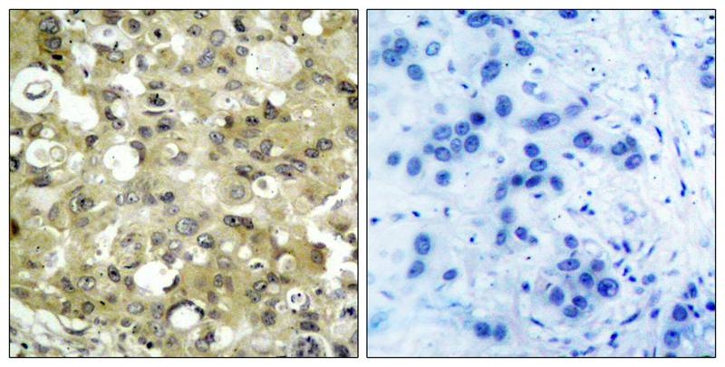 ARG51075 anti-VEGFR2 antibody IHC-P image Immunohistochemistry: paraffin-embedded human breast carcinoma tissue stained with anti-VEGFR-2 antibody ARG51075 (left) or the same antibody preincubated with blocking peptide (right).