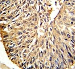 DHFR antibody IHC analysis in formalin fixed and paraffin embedded human lung carcinoma. Predicted molecular weight ~22 kDa.