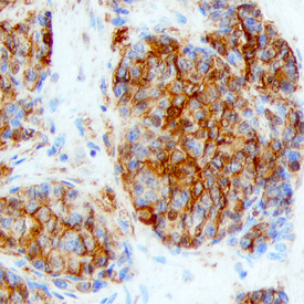 Ly6K in Human Lung Cancer Tissue. Ly6K was detected in immersion fixed paraffin-embedded sections of human lung cancer tissue using Sheep Anti-Human Ly6K Antigen Affinity-purified Polyclonal Antibody (Catalog # AF6648) at 3 µg/mL overnight at 4 °C. Before incubation with the primary antibody, tissue was subjected to heat-induced epitope retrieval using Antigen Retrieval Reagent-Basic (Catalog # CTS013 ). Tissue was stained using the Anti-Sheep HRP-DAB Cell & Tissue Staining Kit (brown; Catalog # CTS019 ) and counterstained with hematoxylin (blue). Specific staining was localized to cytoplasm and plasma membrane of cancer cells. View our protocol for Chromogenic IHC Staining of Paraffin-embedded Tissue Sections .