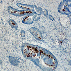 Reg4 in Human Colon Cancer Tissue. Reg4 was detected in immersion fixed paraffin-embedded sections of human colon cancer tissue using Goat Anti-Human Reg4 Antigen Affinity-purified Polyclonal Antibody (Catalog # AF1379) at 10 µg/mL overnight at 4 °C. Before incubation with the primary antibody tissue was subjected to heat-induced epitope retrieval using Antigen Retrieval Reagent-Basic (Catalog # CTS013). Tissue was stained using the Anti-Goat HRP-DAB Cell & Tissue Staining Kit (brown; Catalog # CTS008) and counterstained with hematoxylin (blue). Specific labeling was localized to the cytoplasm of epithelial cells. View our protocol for Chromogenic IHC Staining of Paraffin-embedded Tissue Sections.
