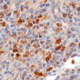 CCR2 in Human Tonsil. CCR2 was detected in immersion fixed paraffin-embedded sections of human tonsil using Mouse Anti-Human CCR2 Monoclonal Antibody (Catalog # MAB150) at 15 µg/mL overnight at 4 °C. Tissue was stained using the Anti-Mouse HRP-DAB Cell & Tissue Staining Kit (brown; Catalog # CTS002 ) and counterstained with hematoxylin (blue). Specific staining was localized to lymphocytes. View our protocol for Chromogenic IHC Staining of Paraffin-embedded Tissue Sections .