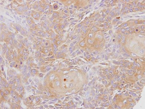 Anti-Alcohol dehydrogenase 1C antibody [N3C3] used in IHC (Formalin-fixed paraffin-embedded sections). GTX101375