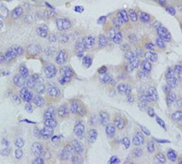 Anti-FBRSL1 antibody used in IHC (Formalin-fixed paraffin-embedded sections). GTX51916