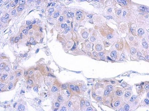Anti-MTMR12 antibody used in IHC (Formalin-fixed paraffin-embedded sections). GTX119163