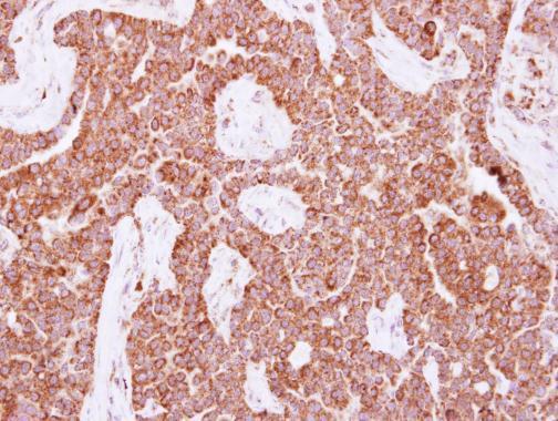 Anti-NUDT3 antibody used in IHC (Formalin-fixed paraffin-embedded sections). GTX115595
