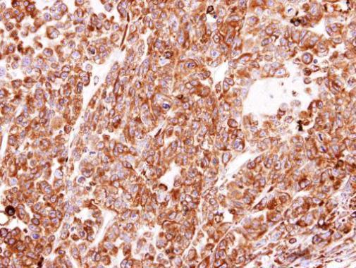 Anti-PDI antibody [N1N3] used in IHC (Formalin-fixed paraffin-embedded sections). GTX101468