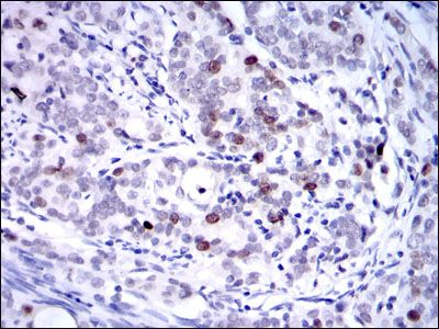 Anti-KID antibody [5F3] used in IHC (Formalin-fixed paraffin-embedded sections). GTX60506