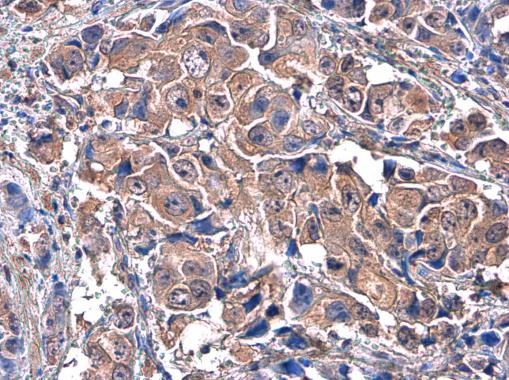 Anti-c-Met antibody [GT556] used in IHC (Formalin-fixed paraffin-embedded sections). GTX631992