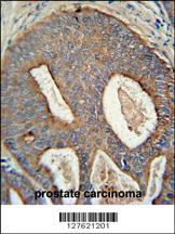 POTEB antibody (C-term) (Cat. #AP10032b) immunohistochemistry analysis in formalin fixed and paraffin embedded human prostate carcinoma followed by peroxidase conjugation of the secondary antibody and DAB staining. This data demonstrates the use of the POTEB antibody (C-term) for immunohistochemistry. Clinical relevance has not been evaluated.