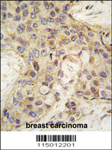 Formalin-fixed and paraffin-embedded human breast carcinoma tissue reacted with ANGEL2 antibody (Center) (Cat.#AP2749c), which was peroxidase-conjugated to the secondary antibody, followed by DAB staining. This data demonstrates the use of this antibody for immunohistochemistry; clinical relevance has not been evaluated.