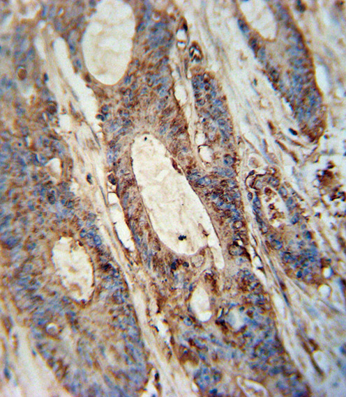 FAM46A antibody (Center) (Cat. #AP10394c) immunohistochemistry analysis in formalin fixed and paraffin embedded human colon carcinoma followed by peroxidase conjugation of the secondary antibody and DAB staining. This data demonstrates the use of the FAM46A antibody (Center) for immunohistochemistry. Clinical relevance has not been evaluated.