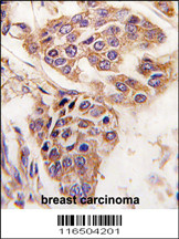 Formalin-fixed and paraffin-embedded human breast carcinoma tissue reacted with C8orf32 antibody (Center), which was peroxidase-conjugated to the secondary antibody, followed by DAB staining. This data demonstrates the use of this antibody for immunohistochemistry; clinical relevance has not been evaluated.