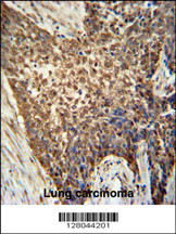 METTL4 antibody (C-term) (Cat. #AP10377b) immunohistochemistry analysis in formalin fixed and paraffin embedded human Lung carcinoma followed by peroxidase conjugation of the secondary antibody and DAB staining. This data demonstrates the use of the METTL4 antibody (C-term) for immunohistochemistry. Clinical relevance has not been evaluated.