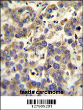 LYPD4 antibody (Center) (Cat. #AP10344c) immunohistochemistry analysis in formalin fixed and paraffin embedded human testis carcinoma followed by peroxidase conjugation of the secondary antibody and DAB staining.This data demonstrates the use of the LYPD4 antibody (Center) for immunohistochemistry. Clinical relevance has not been evaluated.