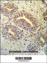 CWC15 Antibody (Center) (Cat. #AP4809c) IHC analysis in formalin fixed and paraffin embedded prostate carcinoma followed by peroxidase conjugation of the secondary antibody and DAB staining. This data demonstrates the use of the CWC15 Antibody (Center) for immunohistochemistry. Clinical relevance has not been evaluated.