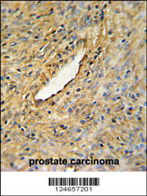 CEP63 Antibody (Center) (Cat. #AP4805c) IHC analysis in formalin fixed and paraffin embedded prostate carcinoma followed by peroxidase conjugation of the secondary antibody and DAB staining. This data demonstrates the use of the CEP63 Antibody (Center)) for immunohistochemistry. Clinical relevance has not been evaluated.
