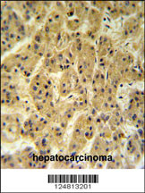 SC24A Antibody (Center) (Cat. #AP4701c) IHC analysis in formalin fixed and paraffin embedded hepatocarcinoma followed by peroxidase conjugation of the secondary antibody and DAB staining. This data demonstrates the use of the SC24A Antibody (Center) for immunohistochemistry. Clinical relevance has not been evaluated.