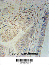 CCD92 Antibody (Center) (Cat. #AP5018c) immunohistochemistry analysis in formalin fixed and paraffin embedded human colon carcinoma followed by peroxidase conjugation of the secondary antibody and DAB staining. This data demonstrates the use of the CCD92 Antibody (Center) for immunohistochemistry. Clinical relevance has not been evaluated.