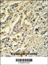 ASM3A Antibody (C-term) (Cat. #AP4977b) IHC analysis in formalin fixed and paraffin embedded breast carcinoma followed by peroxidase conjugation of the secondary antibody and DAB staining. This data demonstrates the use of the ASM3A Antibody (C-term) for immunohistochemistry. Clinical relevance has not been evaluated.