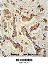 FA20A Antibody (N-term) (Cat. #AP4969a) immunohistochemistry analysis in formalin fixed and paraffin embedded human breast carcinoma tissue followed by peroxidase conjugation of the secondary antibody and DAB staining. This data demonstrates the use of the FA20A Antibody (N-term) for immunohistochemistry. Clinical relevance has not been evaluated.