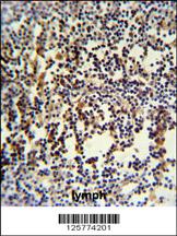 ANR49 Antibody (Center) (Cat. #AP4966c) IHC analysis in formalin fixed and paraffin embedded human lymph carcinoma followed by peroxidase conjugation of the secondary antibody and DAB staining. This data demonstrates the use of the ANR49 Antibody (Center) for immunohistochemistry. Clinical relevance has not been evaluated.