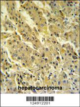 PSG7 Antibody (C-term) (Cat. #AP4939b) IHC analysis in formalin fixed and paraffin embedded hepatocarcinoma followed by peroxidase conjugation of the secondary antibody and DAB staining. This data demonstrates the use of the PSG7 Antibody (C-term) for immunohistochemistry. Clinical relevance has not been evaluated.