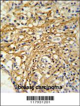 DC13 Antibody (N-term) (Cat. #AP4915a) IHC analysis in formalin fixed and paraffin embedded human breast carcinoma followed by peroxidase conjugation of the secondary antibody and DAB staining. This data demonstrates the use of the DC13 Antibody (N-term) for immunohistochemistry. Clinical relevance has not been evaluated.