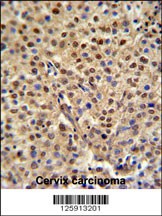 C19orf21 Antibody (N-term) (Cat. #AP4851a) IHC analysis in formalin fixed and paraffin embedded human cervix carcinoma followed by peroxidase conjugation of the secondary antibody and DAB staining. This data demonstrates the use of the C19orf21 Antibody (N-term) for immunohistochemistry. Clinical relevance has not been evaluated.