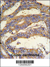 RSAD1 Antibody (C-term) (Cat. #AP5262b) IHC analysis in formalin fixed and paraffin embedded human colon carcinoma followed by peroxidase conjugation of the secondary antibody and DAB staining. This data demonstrates the use of the RSAD1 Antibody (C-term) for immunohistochemistry. Clinical relevance has not been evaluated.