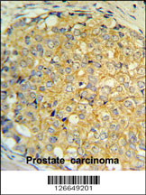RNASEK Antibody (Center) (Cat. #AP5259c) IHC analysis in formalin fixed and paraffin embedded human prostate carcinoma followed by peroxidase conjugation of the secondary antibody and DAB staining. This data demonstrates the use of the RNASEK Antibody (Center) for immunohistochemistry. Clinical relevance has not been evaluated.