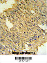 MFRN2 Antibody (N-term) (Cat. #AP5244a) IHC analysis in formalin fixed and paraffin embedded human lung carcinoma followed by peroxidase conjugation of the secondary antibody and DAB staining. This data demonstrates the use of the MFRN2 Antibody (N-term) for immunohistochemistry. Clinical relevance has not been evaluated.